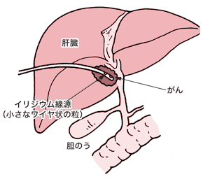 図:胆管がんに対する腔内照射