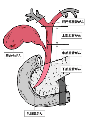 図：胆道がん