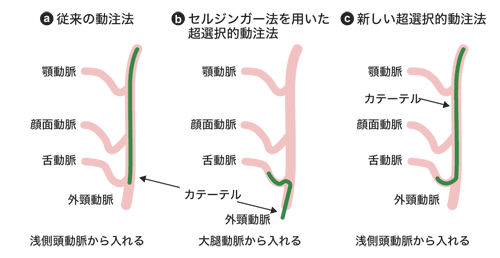 図:カテーテルを挿入する方法