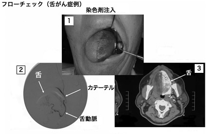 カテーテルの腫瘍栄養動脈への挿入確認
