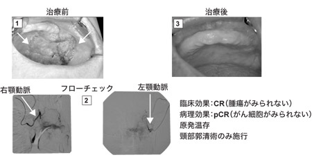 上顎歯肉がんの症例