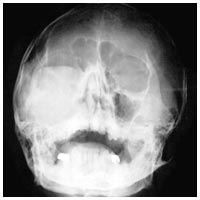 レントゲン写真：Aさんの上顎洞がん