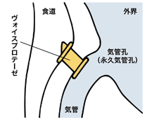 図:ヴォイスプロテーゼの装着の仕方