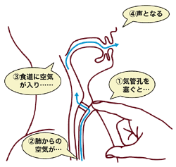 図：気管食道シャント法で声が出る仕組み