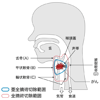 図：喉頭の構造と全摘術、亜全摘術の切除範囲