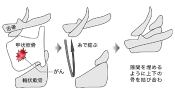 図：横から見た喉頭亜全摘術の簡略図