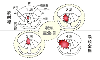 図：上から見た声門がんの進行状況別の治療方法