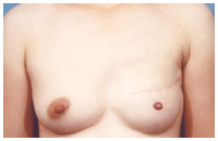 写真：乳頭再建