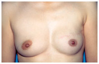 写真：乳輪をつくる