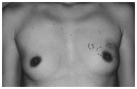写真：皮下乳腺全摘術前