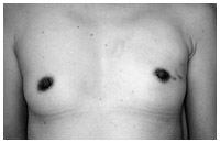 写真：皮下乳腺全摘術＋同時再建