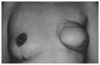 写真2：他院の乳房再建（筋皮弁法）