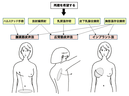 図：どの再建法が向く？
