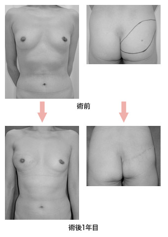 写真：穿通枝皮弁による乳房同時再建術の前後