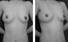 写真：エキスパンダー除去後に、下腹部からの皮弁移植と乳頭乳輪再建術を行った