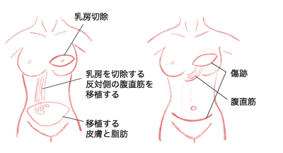 図:腹直筋皮弁