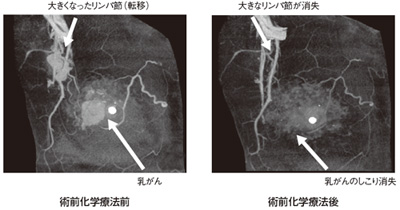 図7 術前化学療法の効果