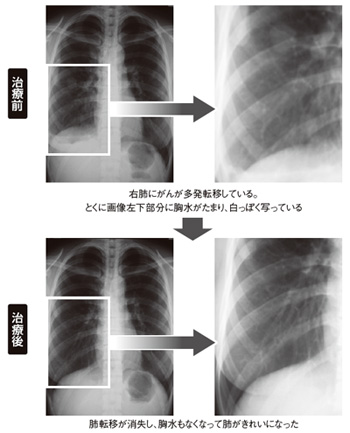 写真6 XC療法が著効したトリプルネガティブ乳がんの症例
