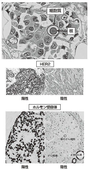 図6 顕微鏡で見た乳がんのがん細胞の様子