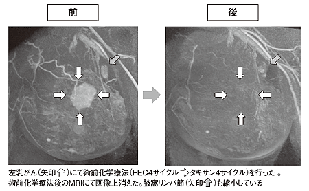 図2 術前化学療法で腫瘍が完全に消失した例（MRI画像）