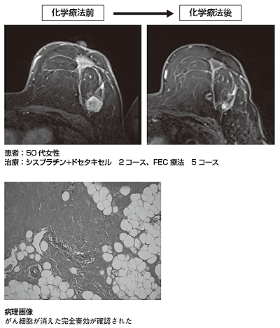 図7 シスプラチンを併用した術前化学療法によって完全奏効となった症例