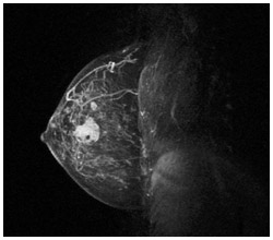 乳房MRIの写真