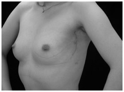 写真:乳房温存手術治療後の症例