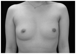 写真：乳房温存手術治療後の症例