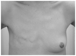 写真：胸筋温存乳房切除術治療後の症例