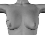 乳房円状切除術