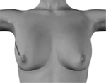 乳房扇状切除術