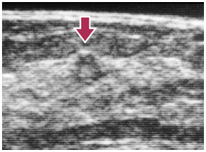 写真：超音波でとらえられた早期の微小乳がん（0.5cm）