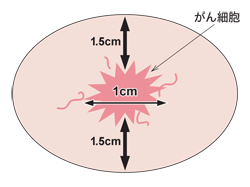 図：アイスボールと摘出できるがん細胞の大きさ