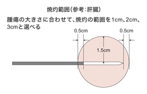 図:ラジオ波焼灼療法の焼灼範囲