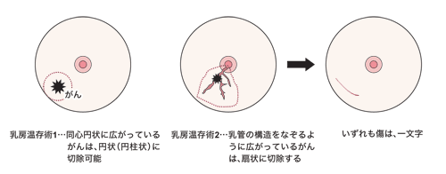 図：乳房温存術の種類
