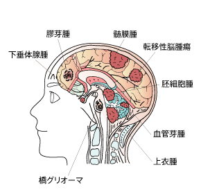 脳腫瘍の主な種類