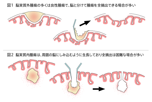 手術の簡単な概念図