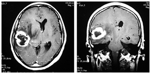 51才 女性 膠芽腫 治療前後のMRI写真