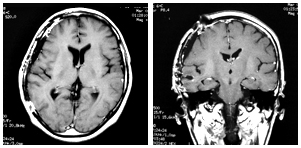 51才 女性　膠芽腫　治療前後のMRI写真