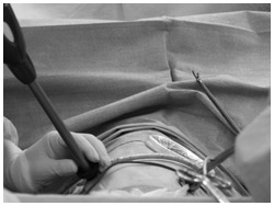写真：胸腔鏡下手術の様子