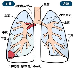図：肺とがんのできる部位