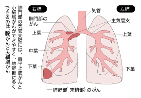 肺とがんのできる部位