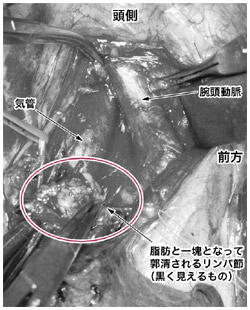 写真：右上葉肺がん対する縦隔リンパ節郭清