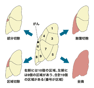 図：肺がん手術のいろいろ
