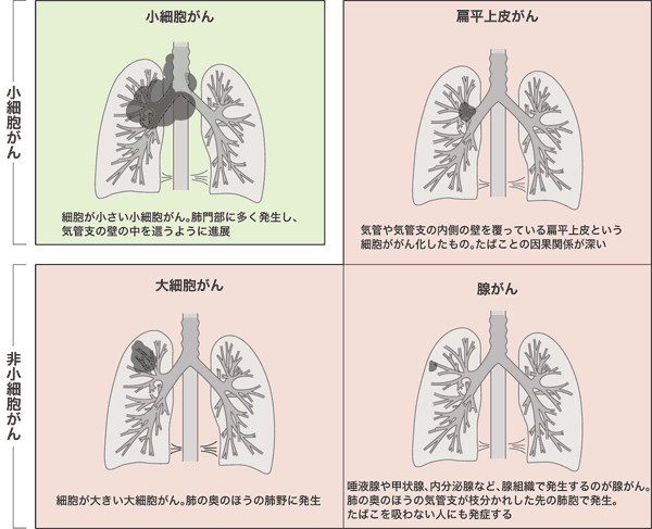 図：肺がんは組織型の違いで4つに分けられる