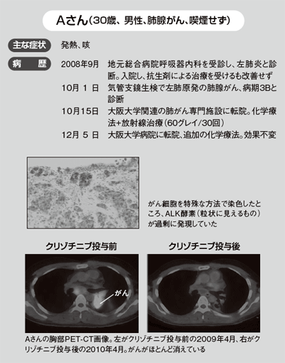 Aさん(30歳男性、喫煙歴なし)