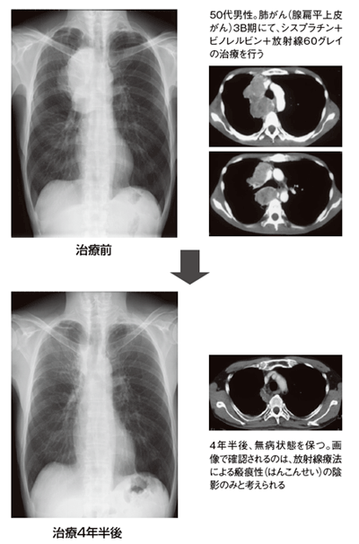 化学放射線療法で腫瘍が縮小した患者さんの肺画像