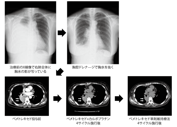 図3 肺腺がんになった66歳の女性の症例