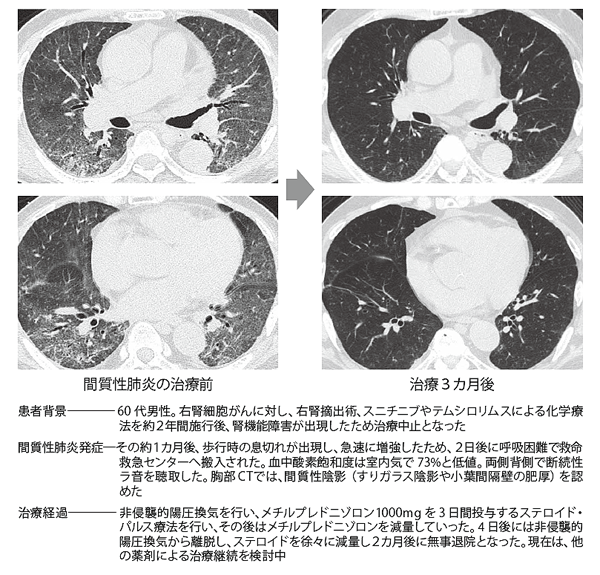 図6　抗がん剤による間質性肺炎の画像