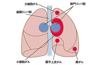 図2 肺がん組織型分類図